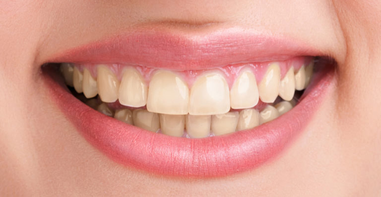 blanqueamiento-antes comparación_blanqueamiento_dental_profesional_antes