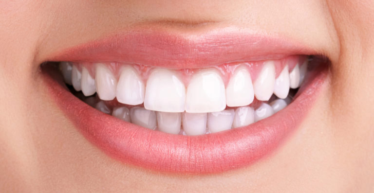 comparación_blanqueamiento_dental_profesional_despues