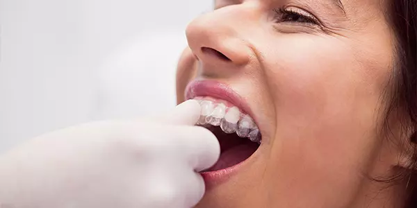 alineadores_dentales_invisibles