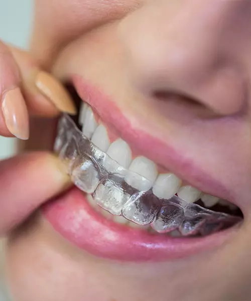 colocacion_alineadores_dentales_invisibles