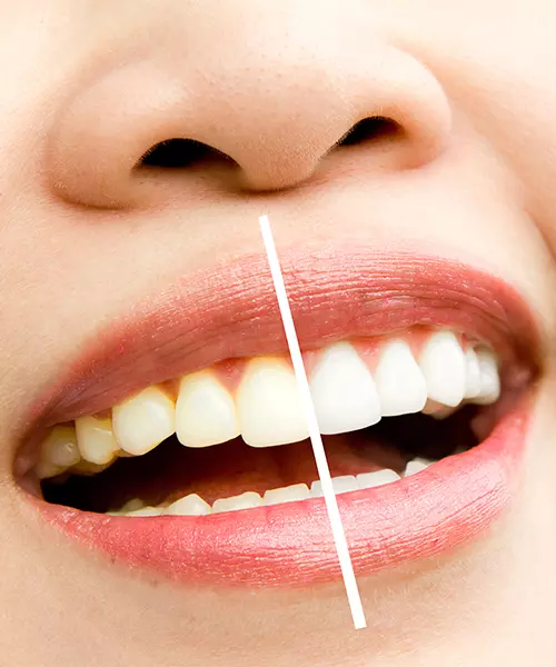 blanqueamiento_dental_profesional