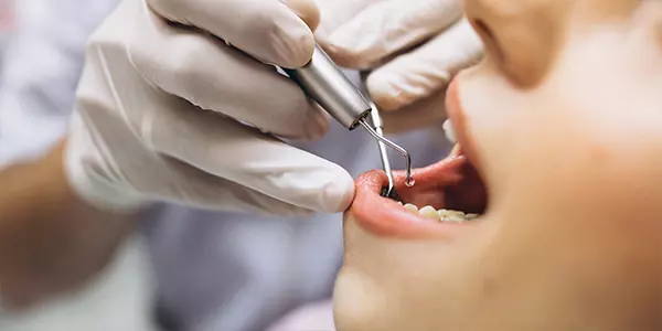 endodoncia_tratamiento_conducto