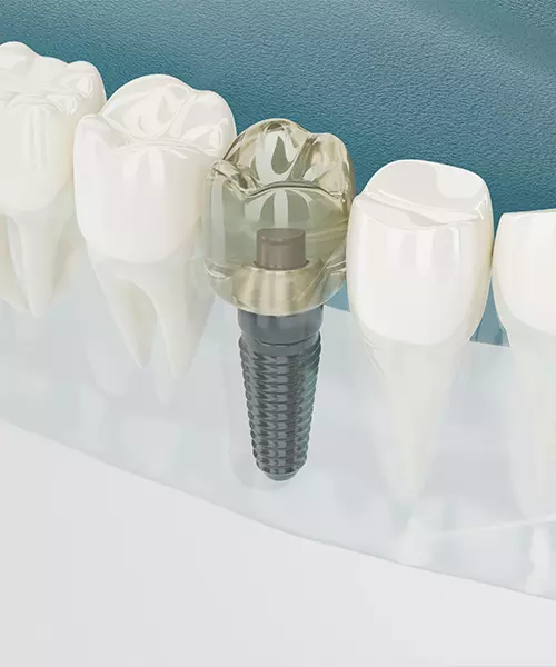 implantes_dentales_esteticos