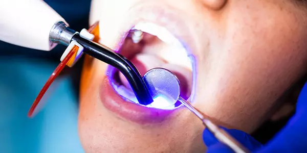 resina_dental_estetica