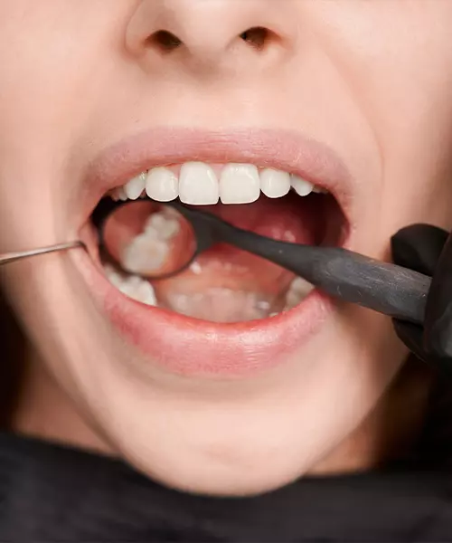 resina_dental_estetica_recuperer_la_sonrisa