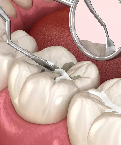 selladores_dentales_preventivos