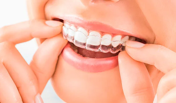 alineadores_dentales_invisibles